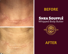 shea butter for scars before and after